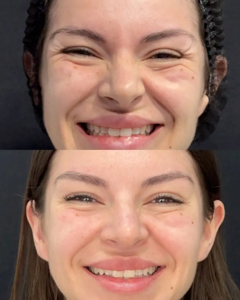 Antes e depois de uma paciente da Vence Clinic