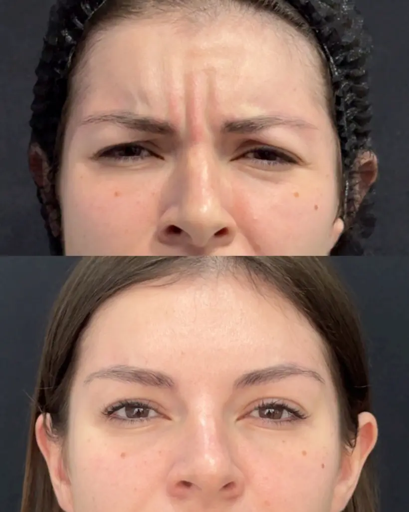 Antes e depois de uma paciente da Vence Clinic