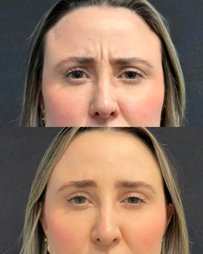 Antes e depois de uma paciente da Vence Clinic