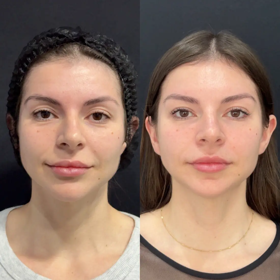 Antes e depois de uma paciente da Vence Clinic