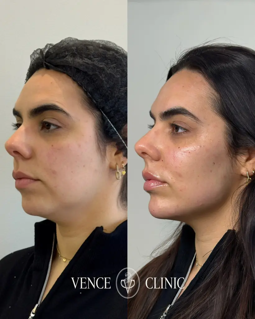 Antes e depois de uma paciente da Vence Clinic