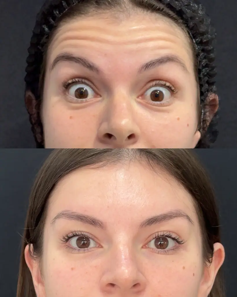 Antes e depois de uma paciente da Vence Clinic